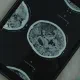 Болест на Кройцфелд-Якоб - какво трябва да знаем за рядкото заболяване на мозъка