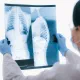 Остър респираторен дистрес синдром - какво знаем за новите терапии през 2026 година